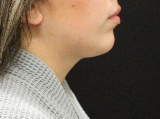 Liposuction Case 49 - After