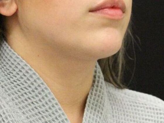 Liposuction: Case 49 - After