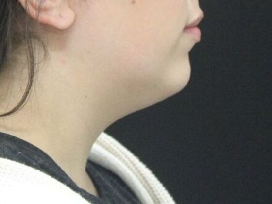 Liposuction Case 49 - Before