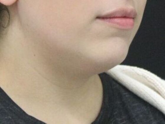 Liposuction: Case 49 - Before