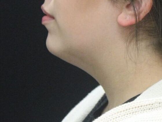 Liposuction: Case 49 - Before