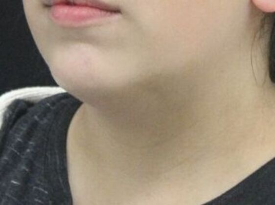 Liposuction: Case 49 - Before