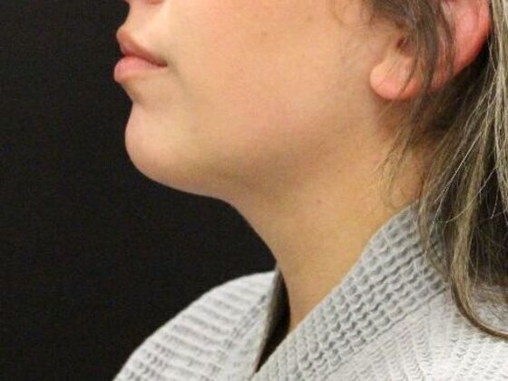 Liposuction: Case 49 - After