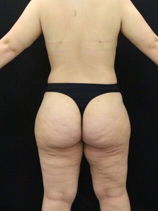 Thigh Lift & Reduction: Case 8 - After