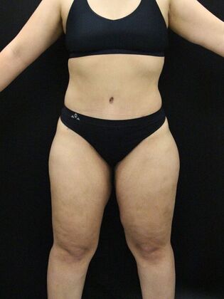 Thigh Lift & Reduction Case 8 - After