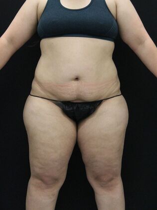 Thigh Lift & Reduction Case 8 - Before