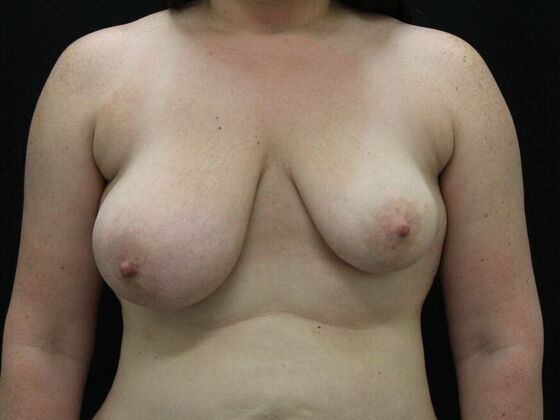 Breast Lift & Breast Lift Augmentation Case 43 - Before