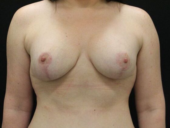 Breast Lift & Breast Lift Augmentation Case 43 - After