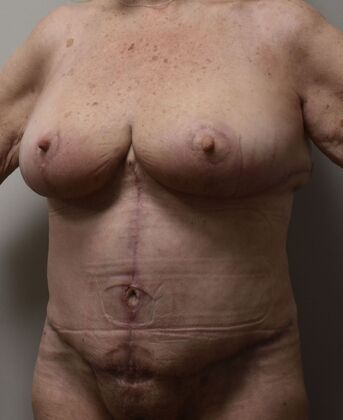 Mommy Makeover: Case 319 - After