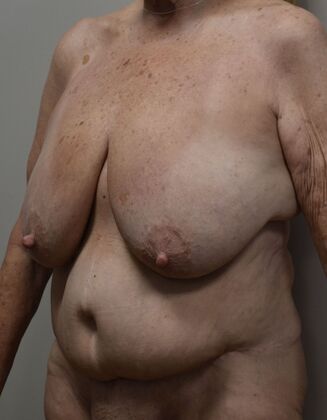 Massive Weight Loss : Case 156 - Before