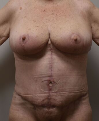 Massive Weight Loss : Case 156 - After