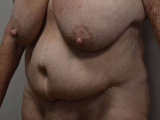 Tummy Tuck (Abdominoplasty): Case 501 - Before