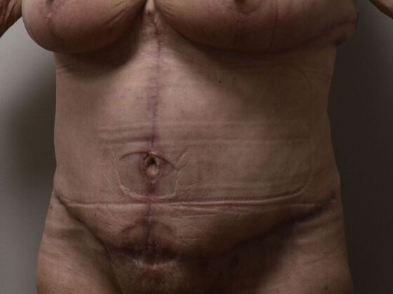 Tummy Tuck (Abdominoplasty): Case 501 - After