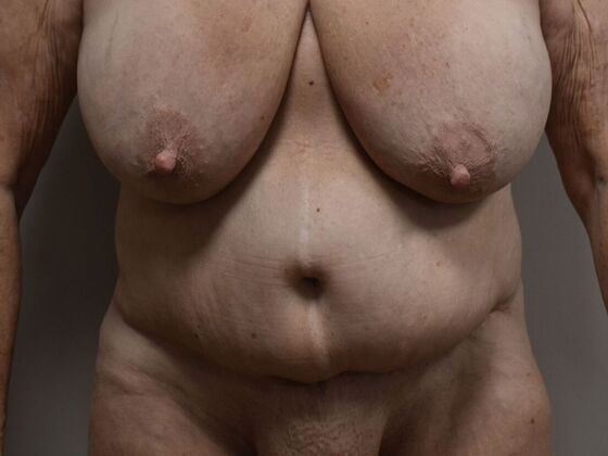 Tummy Tuck (Abdominoplasty): Case 501 - Before