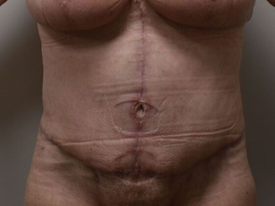 Tummy Tuck (Abdominoplasty): Case 501 - After