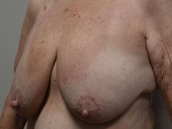 Breast Lift (Mastopexy): Case 221 - Before
