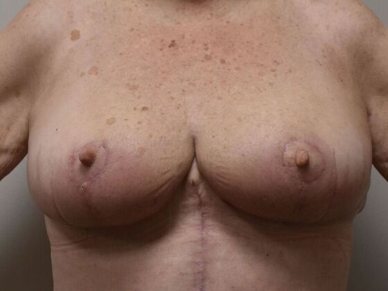 Breast Lift (Mastopexy) Case 221 - After