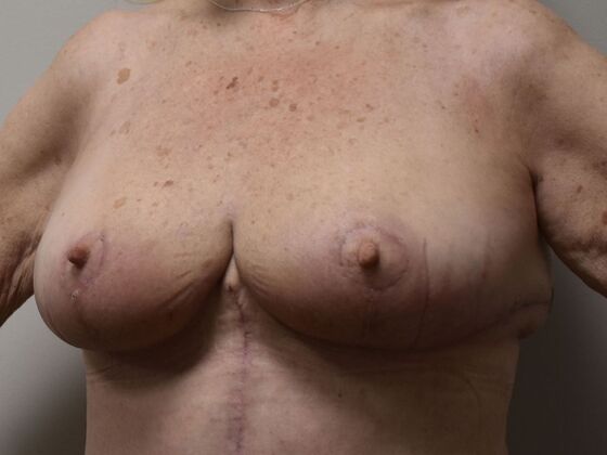 Breast Lift (Mastopexy): Case 221 - After