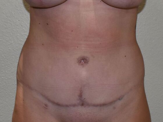 Tummy Tuck (Abdominoplasty): Case 502 - After