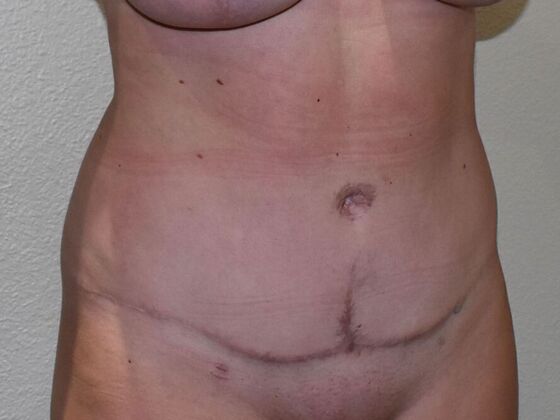 Tummy Tuck (Abdominoplasty): Case 502 - After