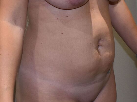 Tummy Tuck (Abdominoplasty): Case 502 - Before