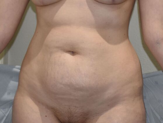 Tummy Tuck (Abdominoplasty): Case 503 - Before