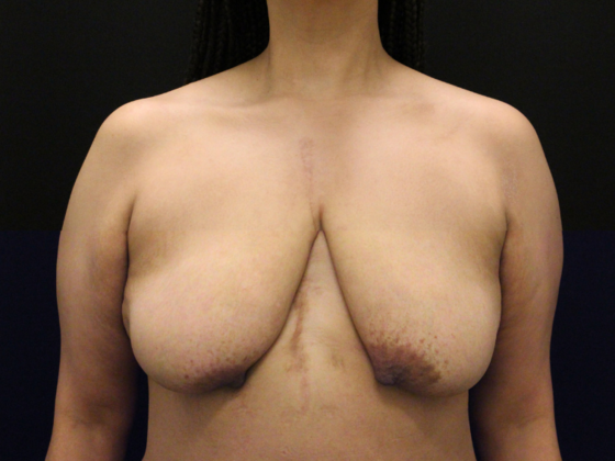 Breast Reduction & Lift Case 27 - Before