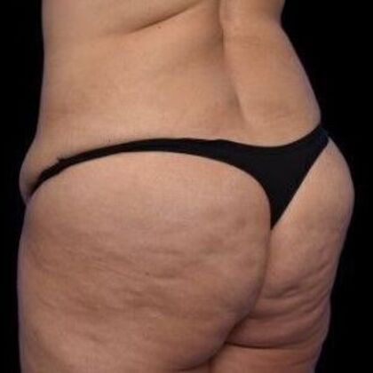 Brazilian Butt Lift: Case 3 - Before