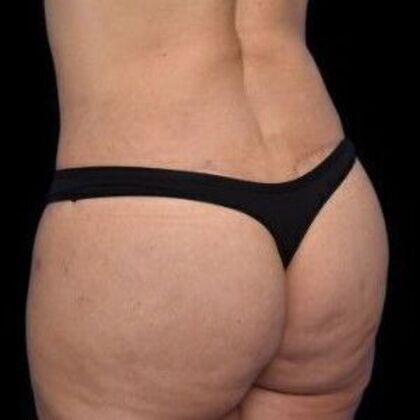 Brazilian Butt Lift: Case 3 - After
