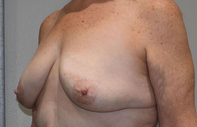 Breast Augmentation w/ Lift: Case 548 - Before