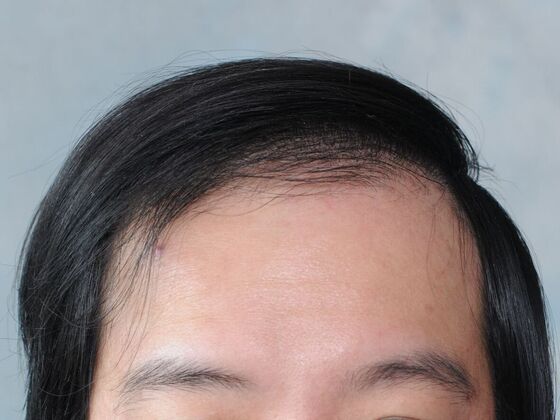 FUT Hair Restoration: Case 44 - After