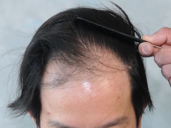 FUT Hair Restoration Case 44 - Before