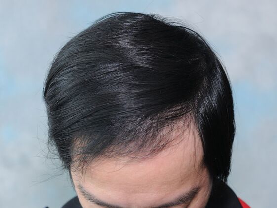 FUT Hair Restoration Case 44 - After