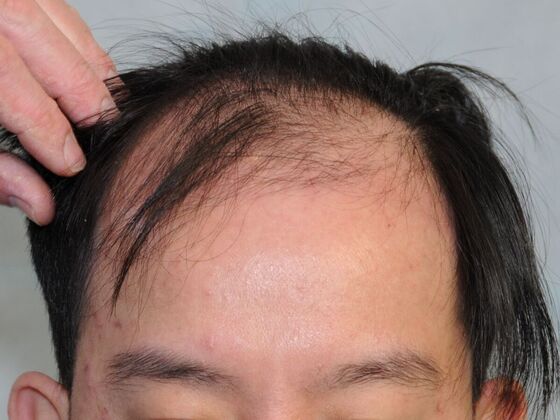 FUT Hair Restoration: Case 44 - Before