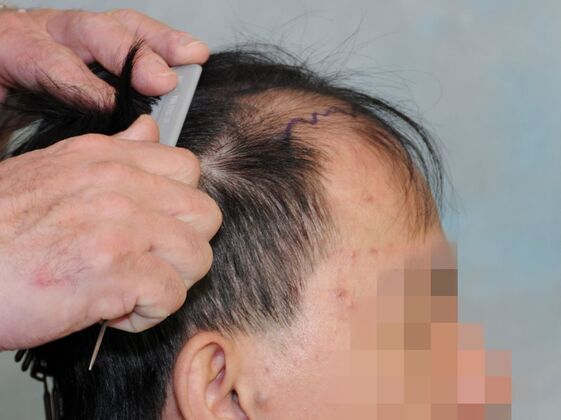 FUT Hair Restoration: Case 44 - Before