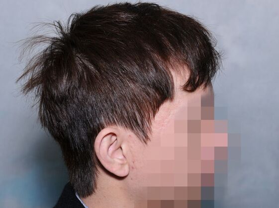 FUT Hair Restoration: Case 44 - After