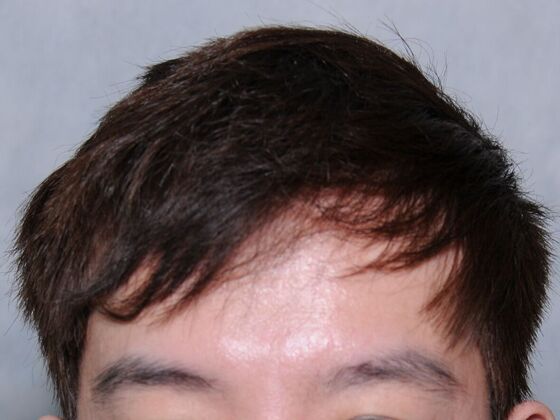 FUT Hair Restoration: Case 44 - After