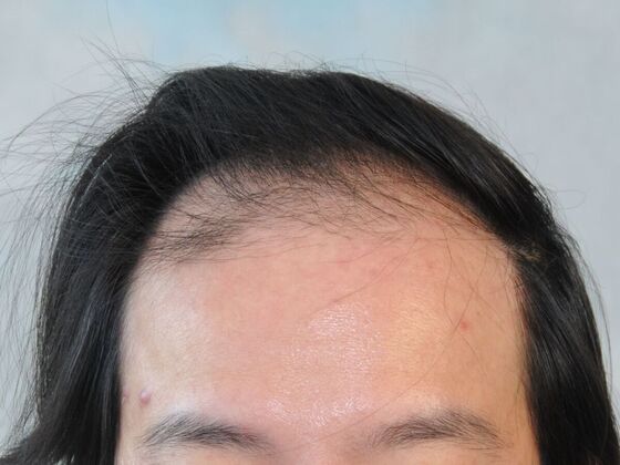 FUT Hair Restoration: Case 44 - Before