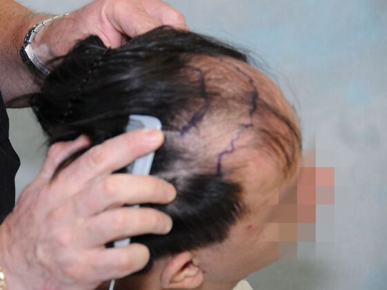 FUT Hair Restoration: Case 44 - Before