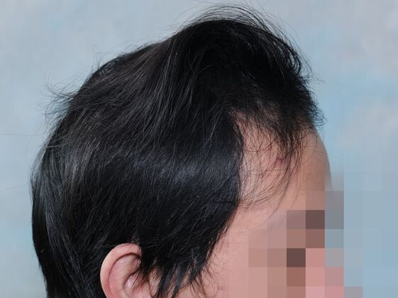 FUT Hair Restoration: Case 44 - After