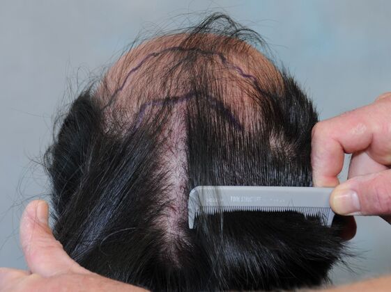 FUT Hair Restoration: Case 44 - Before