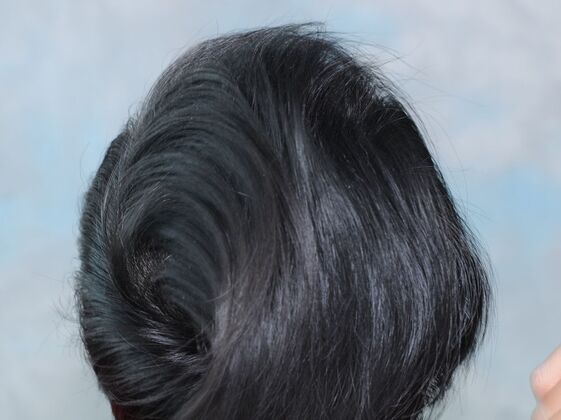 FUT Hair Restoration: Case 44 - After