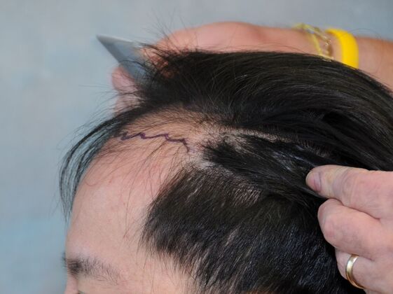 FUT Hair Restoration: Case 44 - Before