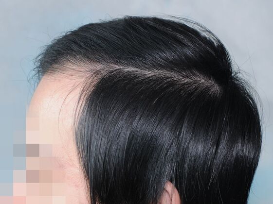 FUT Hair Restoration: Case 44 - After