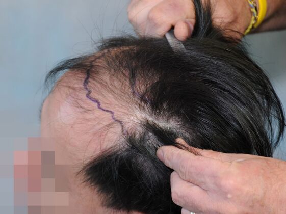 FUT Hair Restoration: Case 44 - Before