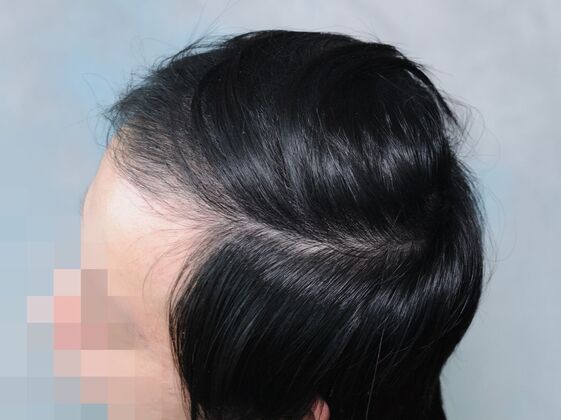 FUT Hair Restoration: Case 44 - After