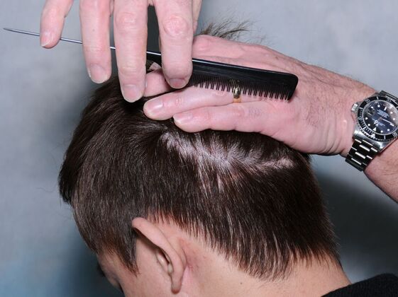 FUT Hair Restoration: Case 44 - After