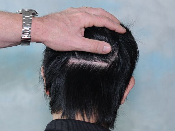 FUT Hair Restoration: Case 44 - Before