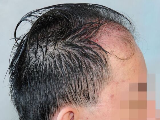 FUT Hair Restoration: Case 44 - Before