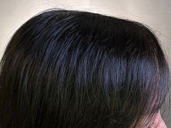 FUT Hair Restoration: Case 44 - After